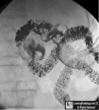 Duodenal Diverticulum